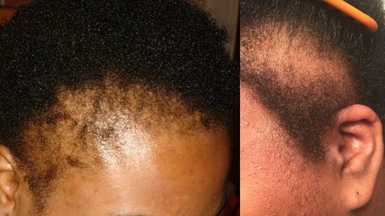 hairline tips