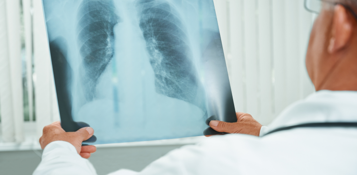 tuberculosis (003)