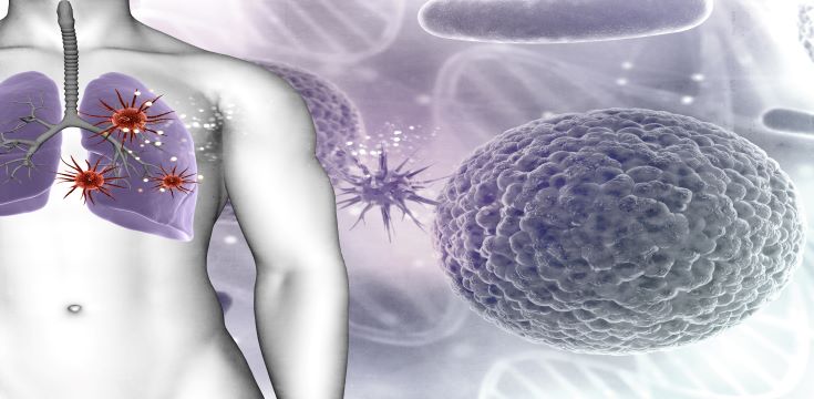 lung_cancer