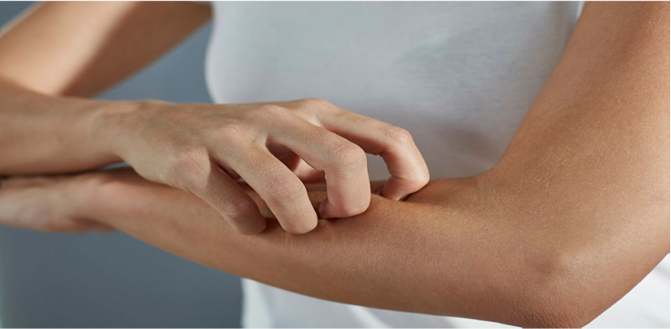 Psoriasis