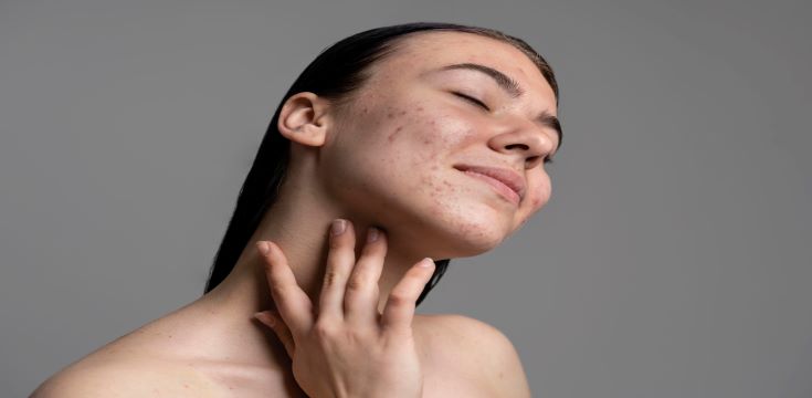 Vitamin D-acne (002)