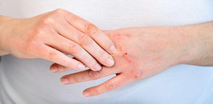 Atopic-Dermatitis