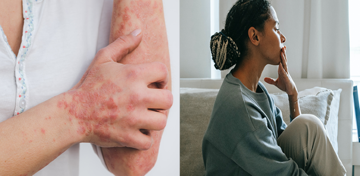 Psoriasis Is #MoreThanSkinDeep