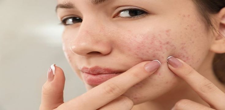 acne-Photo-istock-1