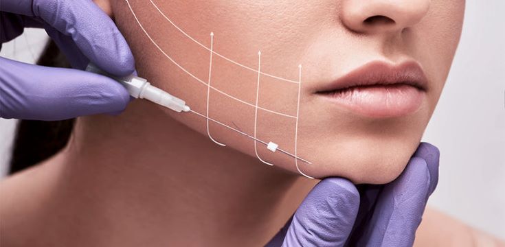 threadlifting