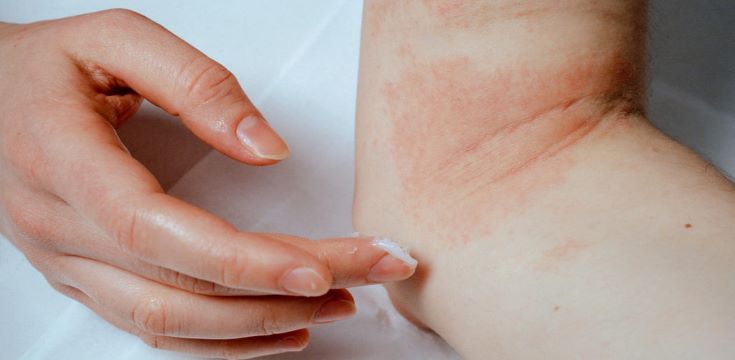 Atopic-eczema