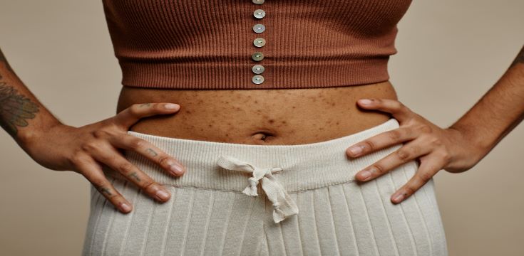 Truncal acne