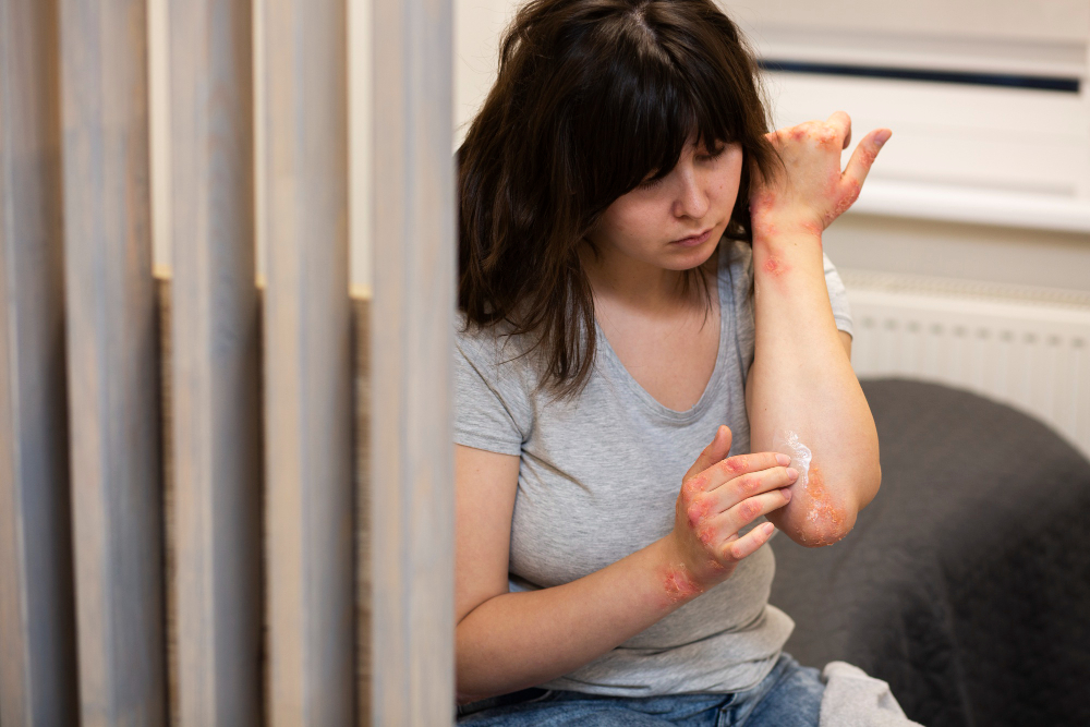 hands-patient-suffering-from-psoriasis